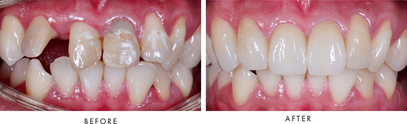 dental implants - before and after