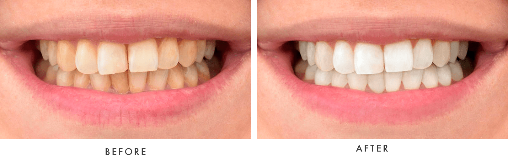 teeth whitening - before and after