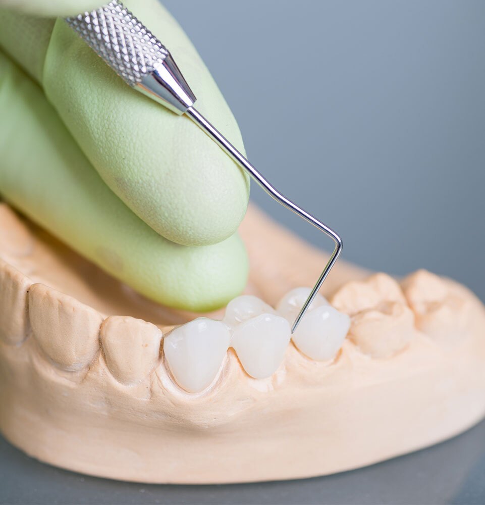 dental bridge model