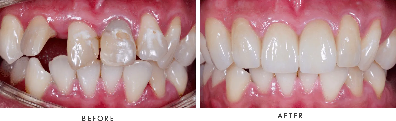 dental implants - before and after