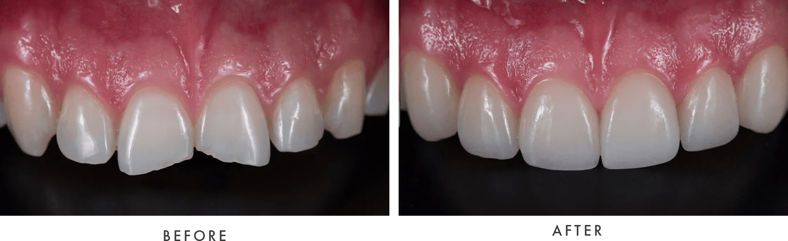 Porcelain Veneers