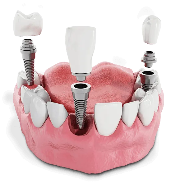 multiple dental implant model