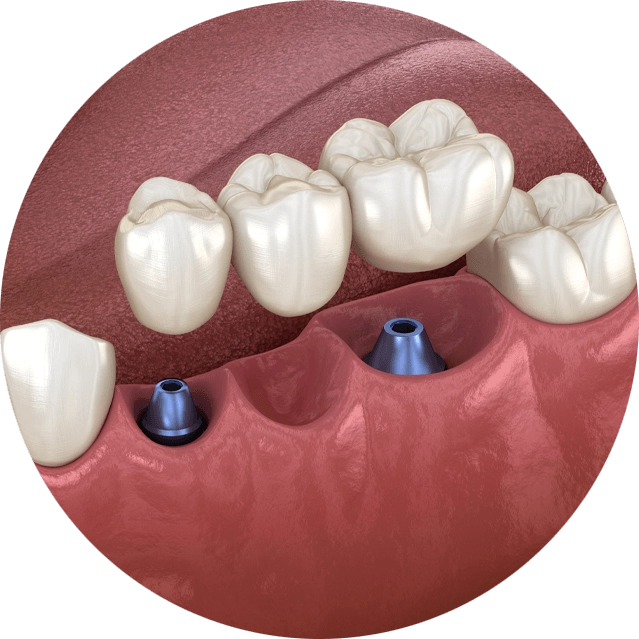 dental implant bridge model