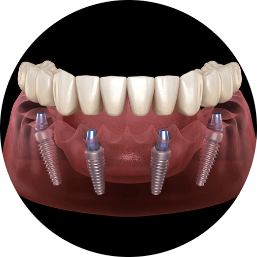 full arch dental implants