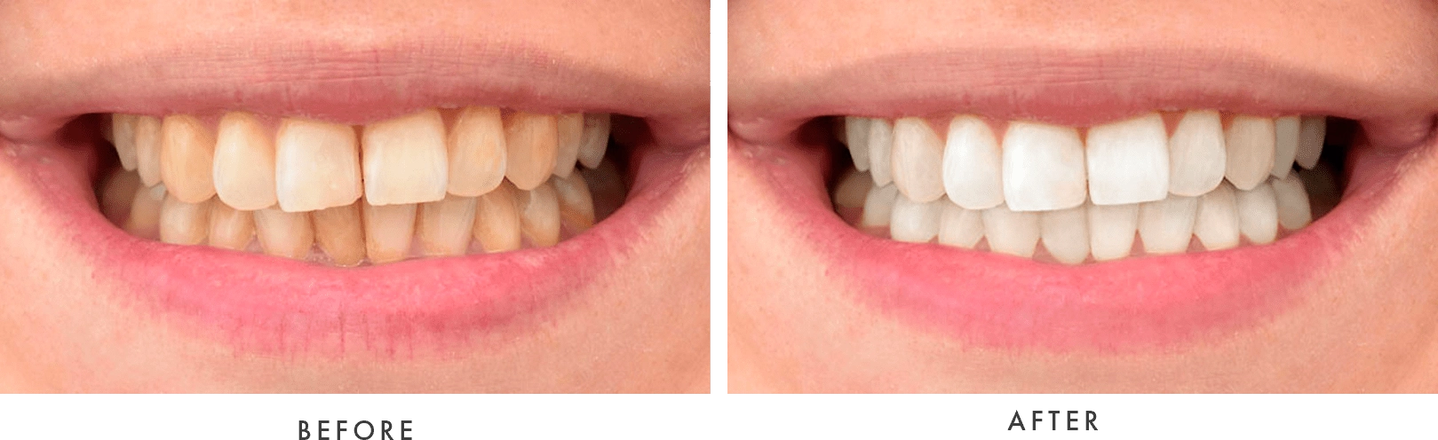 teeth whitening - before and after