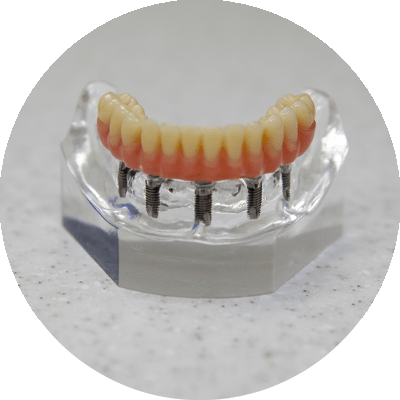 full arch implant model on counter