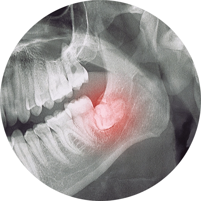 Tooth pain - X ray image