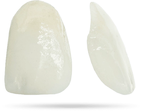 dental veneers