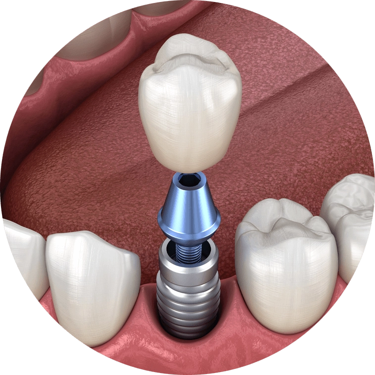 single dental implant model 2