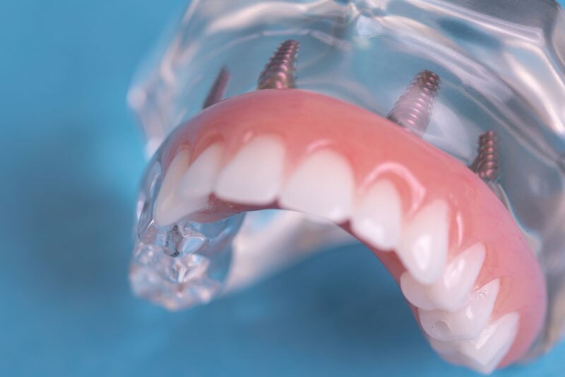 full-arch-dental-implants-model