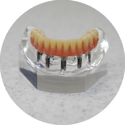 full arch implant model on counter