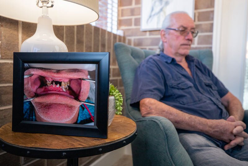 joe_withbeforephoto_beforeimplants