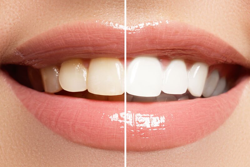 before & after teeth whitening