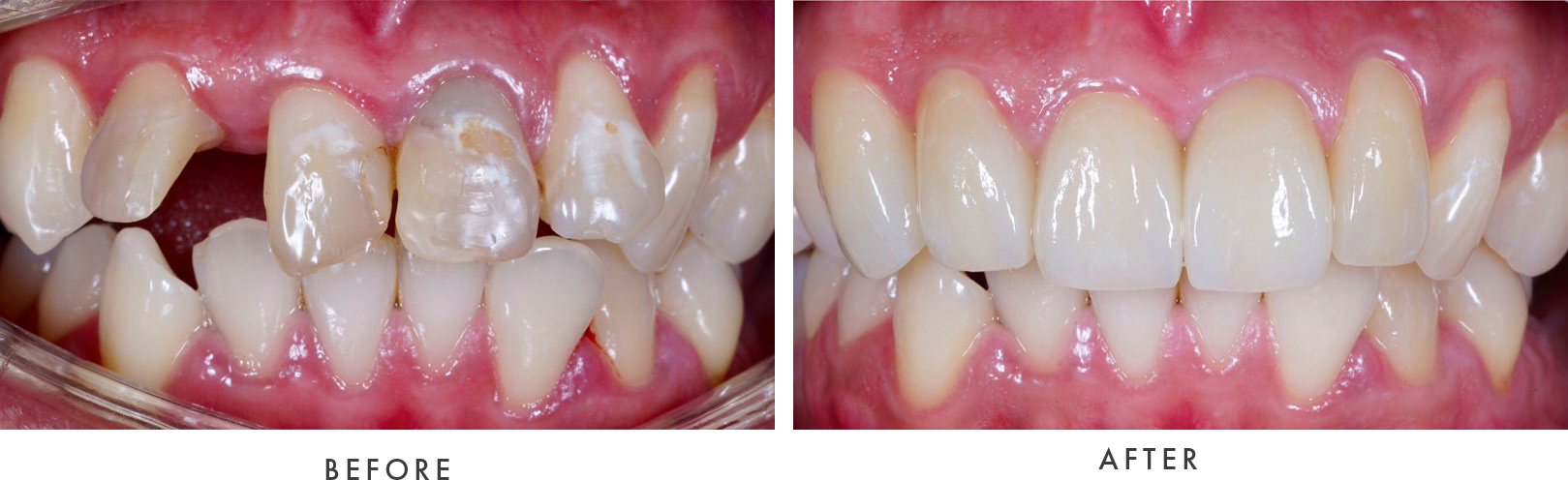 dental implants - before and after