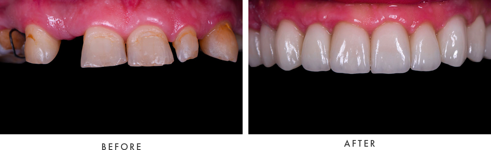 Full Mouth Dental Implants