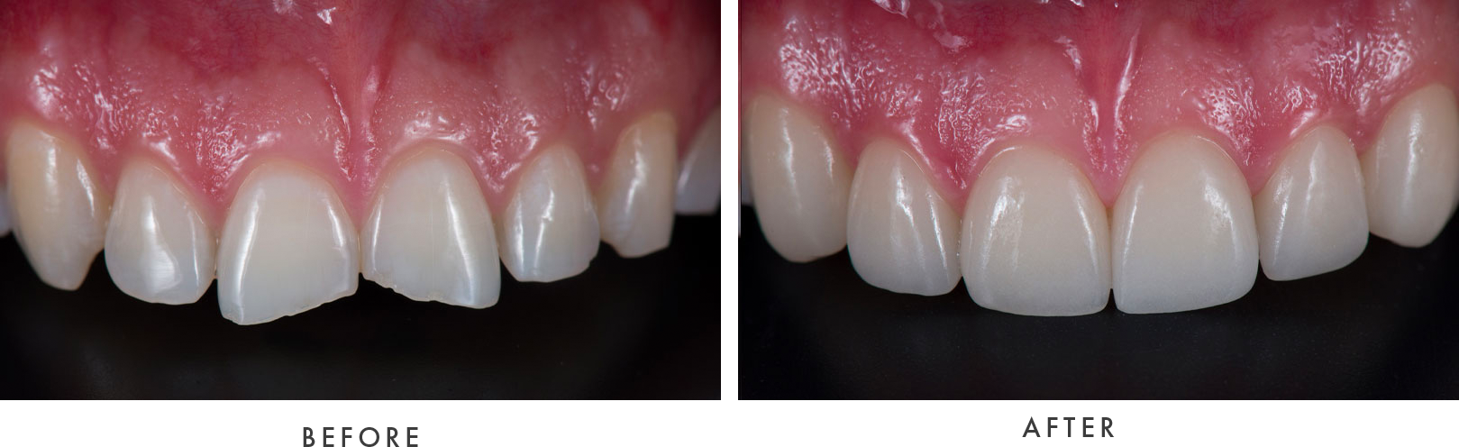 Porcelain Veneers