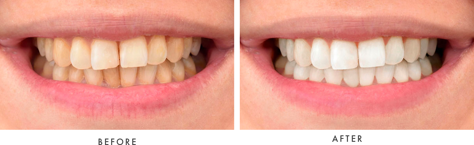 teeth whitening - before and after