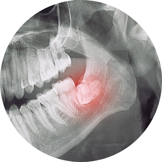 Tooth pain - X ray image