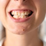 A woman with crooked and yellow teeth