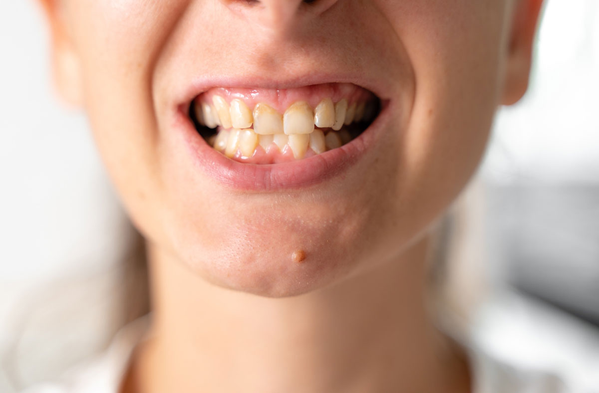 A woman with crooked and yellow teeth