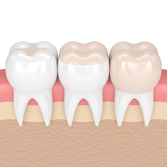 Composite fillings model